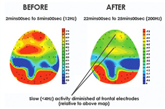 brainwaves